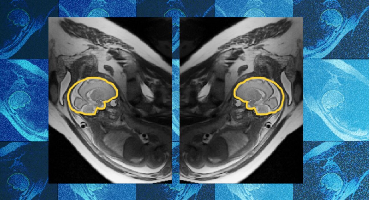 Why teaching AI about symmetry could make prenatal diagnosis more reliable | MIT News