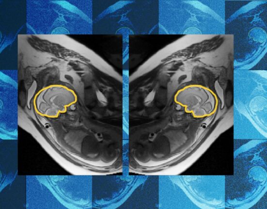 Why teaching AI about symmetry could make prenatal diagnosis more reliable | MIT News